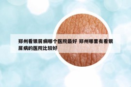 鄭州看銀屑病哪個醫(yī)院最好 鄭州哪里有看銀屑病的醫(yī)院比較好