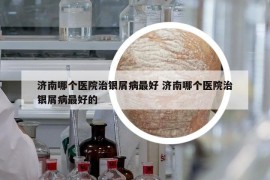 濟南哪個醫(yī)院治銀屑病最好 濟南哪個醫(yī)院治銀屑病最好的