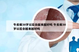 牛皮癬30歲以后會越來越好嗎 牛皮癬30歲以后會越來越好嗎