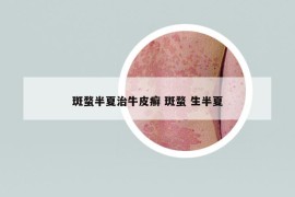 斑蝥半夏治牛皮癬 斑蝥 生半夏