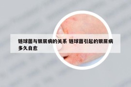 鏈球菌與銀屑病的關(guān)系 鏈球菌引起的銀屑病多久自愈