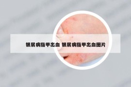 銀屑病指甲出血 銀屑病指甲出血圖片