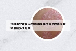環(huán)孢素軟膠囊治療銀屑病 環(huán)孢素軟膠囊治療銀屑病多久見效