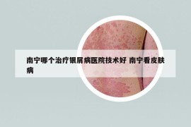 南寧哪個治療銀屑病醫(yī)院技術(shù)好 南寧看皮膚病