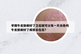 早期牛皮膚癬好了之后就可以有一片白色嗎 牛皮膚癬好了癢抓會(huì)在出?