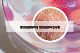 銀屑病瘙癢期 銀屑病癢的厲害