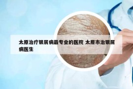 太原治療銀屑病最專業(yè)的醫(yī)院 太原市治銀屑病醫(yī)生