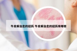 牛皮癬治愈的經(jīng)歷 牛皮癬治愈的經(jīng)歷有哪些