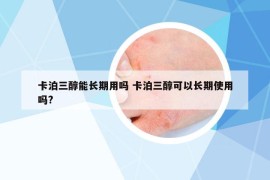 卡泊三醇能長(zhǎng)期用嗎 卡泊三醇可以長(zhǎng)期使用嗎?