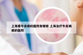 上?？磁Ｆぐ_的醫(yī)院有哪些 上海治療牛皮病癬的醫(yī)院