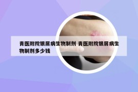 青醫(yī)附院銀屑病生物制劑 青醫(yī)附院銀屑病生物制劑多少錢(qián)