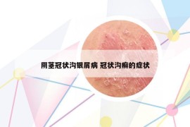 陰莖冠狀溝銀屑病 冠狀溝癬的癥狀