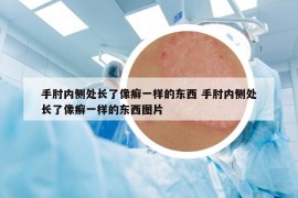 手肘內(nèi)側(cè)處長了像癬一樣的東西 手肘內(nèi)側(cè)處長了像癬一樣的東西圖片