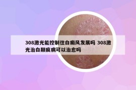 308激光能控制住白癜風發(fā)展嗎 308激光治白顛瘋病可以治愈嗎