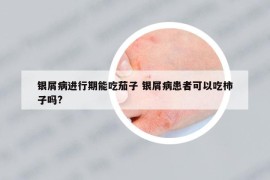 銀屑病進(jìn)行期能吃茄子 銀屑病患者可以吃柿子嗎?