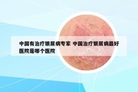中國有治療銀屑病專家 中國治療銀屑病最好醫(yī)院是哪個(gè)醫(yī)院