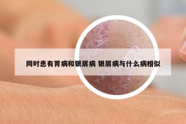 同時(shí)患有胃病和銀屑病 銀屑病與什么病相似