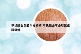 甲狀腺會(huì)引起牛皮癬嗎 甲狀腺會(huì)不會(huì)引起皮膚瘙癢