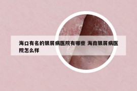 ?？谟忻你y屑病醫(yī)院有哪些 海南銀屑病醫(yī)院怎么樣
