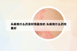 頭癬用什么藥膏好得最快的 頭癬用什么藥效果好