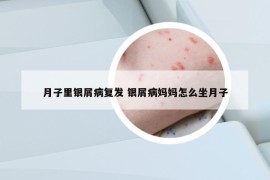 月子里銀屑病復(fù)發(fā) 銀屑病媽媽怎么坐月子