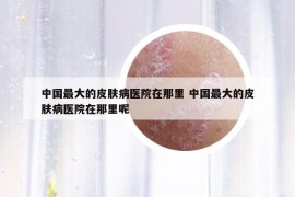 中國(guó)最大的皮膚病醫(yī)院在那里 中國(guó)最大的皮膚病醫(yī)院在那里呢