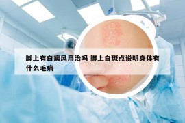 腳上有白癜風(fēng)用治嗎 腳上白斑點說明身體有什么毛病