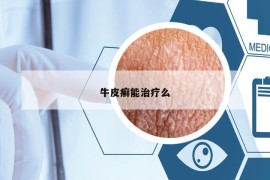 牛皮癬能治療么