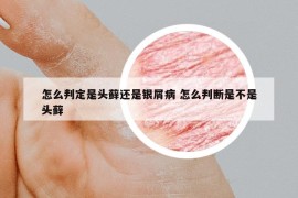 怎么判定是頭蘚還是銀屑病 怎么判斷是不是頭蘚