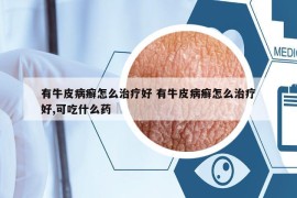 有牛皮病癬怎么治療好 有牛皮病癬怎么治療好,可吃什么藥