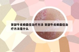 背部牛皮癬最佳治療方法 背部牛皮癬最佳治療方法是什么