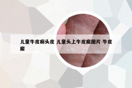 兒童牛皮癬頭皮 兒童頭上牛皮廨圖片 牛皮廨