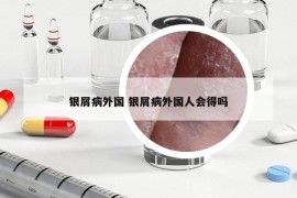 銀屑病外國 銀屑病外國人會得嗎
