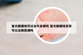 復(fù)方酮康唑可以治牛皮癬嗎 復(fù)方酮康唑軟膏可以治銀屑病嗎