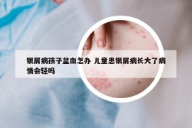 銀屑病孩子盆血怎辦 兒童患銀屑病長(zhǎng)大了病情會(huì)輕嗎