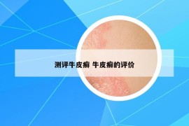 測評牛皮癬 牛皮癬的評價