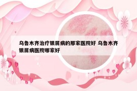 烏魯木齊治療銀屑病的那家醫(yī)院好 烏魯木齊銀屑病醫(yī)院哪家好
