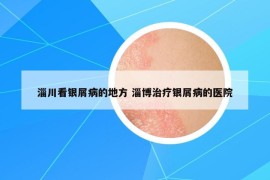淄川看銀屑病的地方 淄博治療銀屑病的醫(yī)院