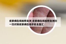 皮膚病在線拍照自測 皮膚病在線拍照自測掃一掃識別皮膚病在線手機名醫(yī)匯