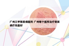 廣州三甲銀屑病醫(yī)院 廣州哪個(gè)醫(yī)院治療銀屑病療效最好