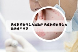 頭皮長(zhǎng)癬有什么方法治療 頭皮長(zhǎng)癬有什么方法治療不用藥