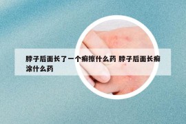 脖子后面長(zhǎng)了一個(gè)癬擦什么藥 脖子后面長(zhǎng)癬涂什么藥