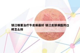 鎮(zhèn)江哪里治療牛皮癬最好 鎮(zhèn)江皮膚病醫(yī)院口碑怎么樣