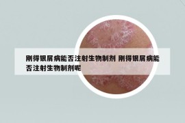 剛得銀屑病能否注射生物制劑 剛得銀屑病能否注射生物制劑呢