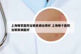上海哪家醫(yī)院治銀屑病治得好 上海哪個醫(yī)院治銀屑病最好