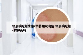銀屑病吃維生素c的作用及功能 銀屑病吃維c有好處嗎