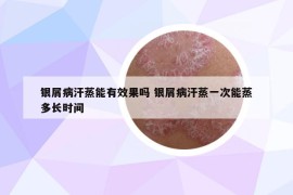 銀屑病汗蒸能有效果嗎 銀屑病汗蒸一次能蒸多長(zhǎng)時(shí)間