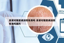 青黛對銀屑病消斑有用嗎 青黛對銀屑病消斑有用嗎圖片