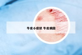 牛皮小癥狀 牛皮病因