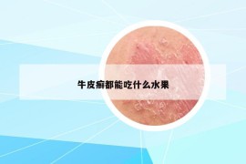 牛皮癬都能吃什么水果